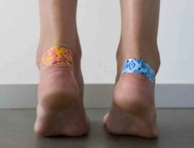 Φουσκάλες στα πόδια: Nα πως να τις εξαφανίσετε γρήγορα